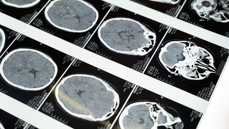 Detailed brain MRI scans displayed on a lightbox, showcasing medical imaging techniques.