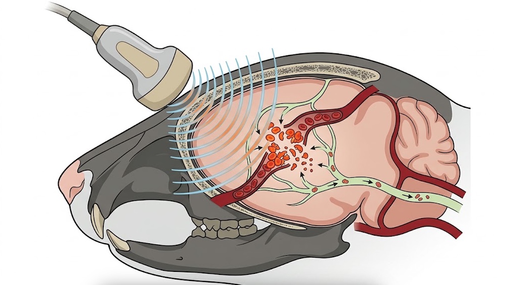 ultrasound clears Intracranial Debris