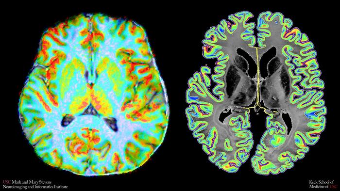 A color map of blood flow through the brain, captured at high resolution with a 7 Tesla MRI scanner. Right: A map showing how densely cells are packed across the brain's outer layers, based on a detailed reference brain atlas. Comparing these two views allowed researchers to create CCSI, the study's new measure of how closely blood supply matches brain cells' energy needs. CREDIT Stevens INI