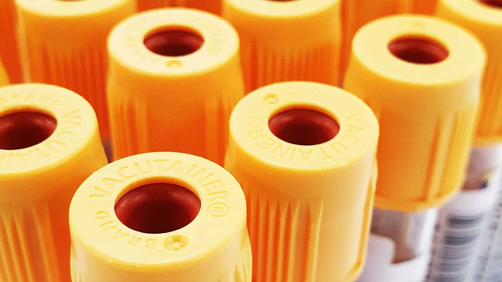 Detailed close-up of several test tubes with yellow caps used in medical testing in a laboratory.